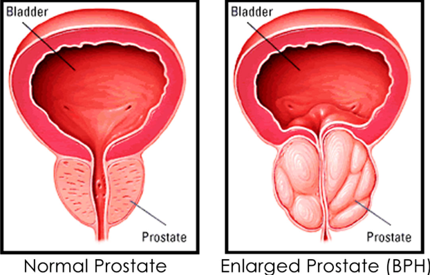 enlarged prostate gland