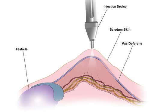 No scalpel no needle vasectomy - La Plata Urological